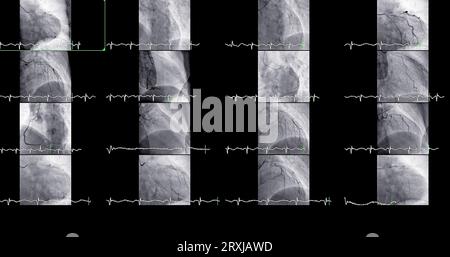 Le cathétérisme cardiaque peut aider le médecin à diagnostiquer et à traiter des problèmes dans votre cœur et vos vaisseaux sanguins qui pourraient autrement causer des problèmes plus importants, tels que Banque D'Images