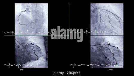 Le cathétérisme cardiaque peut aider le médecin à diagnostiquer et à traiter des problèmes dans votre cœur et vos vaisseaux sanguins qui pourraient autrement causer des problèmes plus importants, tels que Banque D'Images