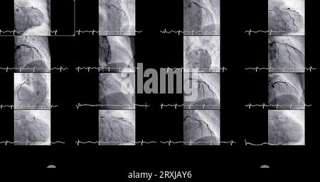 Le cathétérisme cardiaque peut aider le médecin à diagnostiquer et à traiter des problèmes dans votre cœur et vos vaisseaux sanguins qui pourraient autrement causer des problèmes plus importants, tels que Banque D'Images