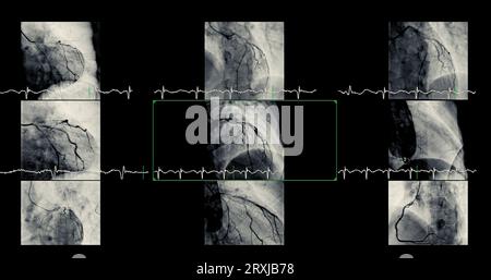 Le cathétérisme cardiaque peut aider le médecin à diagnostiquer et à traiter des problèmes dans votre cœur et vos vaisseaux sanguins qui pourraient autrement causer des problèmes plus importants, tels que Banque D'Images