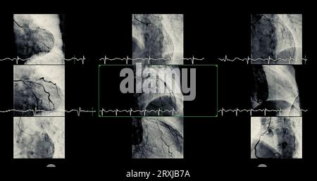 Le cathétérisme cardiaque peut aider le médecin à diagnostiquer et à traiter des problèmes dans votre cœur et vos vaisseaux sanguins qui pourraient autrement causer des problèmes plus importants, tels que Banque D'Images