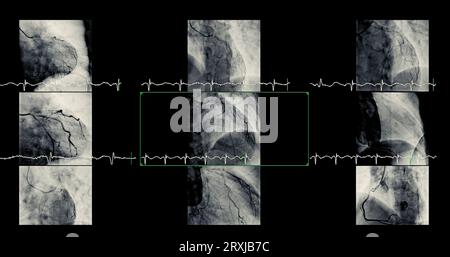 Le cathétérisme cardiaque peut aider le médecin à diagnostiquer et à traiter des problèmes dans votre cœur et vos vaisseaux sanguins qui pourraient autrement causer des problèmes plus importants, tels que Banque D'Images