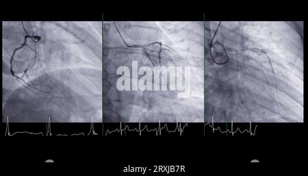 Le cathétérisme cardiaque peut aider le médecin à diagnostiquer et à traiter des problèmes dans votre cœur et vos vaisseaux sanguins qui pourraient autrement causer des problèmes plus importants, tels que Banque D'Images