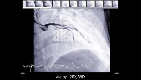 Le cathétérisme cardiaque peut aider le médecin à diagnostiquer et à traiter des problèmes dans votre cœur et vos vaisseaux sanguins qui pourraient autrement causer des problèmes plus importants, tels que Banque D'Images