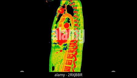 Tomodensitométrie de la vue sagittale thorax en mode couleur pour le diagnostic d'embolie pulmonaire (EP) , de cancer du poumon et de covid-19. Banque D'Images