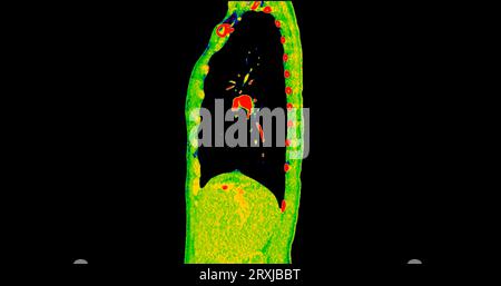 Tomodensitométrie de la vue sagittale thorax en mode couleur pour le diagnostic d'embolie pulmonaire (EP) , de cancer du poumon et de covid-19. Banque D'Images