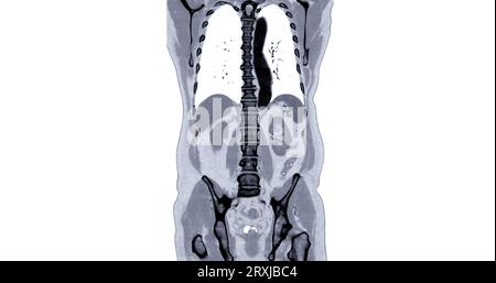 TDM thorax et abdomen avec vue frontale de produit de contraste pour injection pour le diagnostic des douleurs thoraciques et abdominales. Banque D'Images