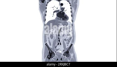 TDM thorax et abdomen avec vue frontale de produit de contraste pour injection pour le diagnostic des douleurs thoraciques et abdominales. Banque D'Images