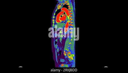 TDM thorax and abdomen avec plan sagittal de produit de contraste pour injection pour le diagnostic des douleurs thoraciques et abdominales. Banque D'Images