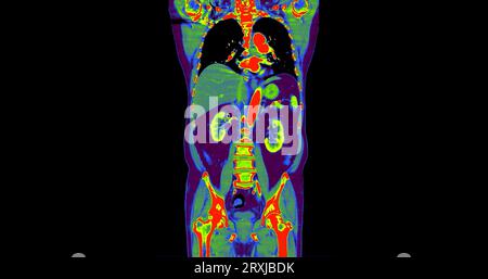 TDM thorax et abdomen avec vue frontale de produit de contraste pour injection pour le diagnostic des douleurs thoraciques et abdominales. Banque D'Images