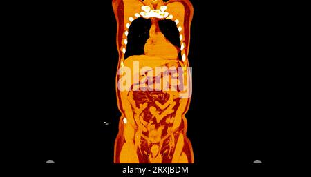 TDM thorax et abdomen avec vue frontale de produit de contraste pour injection pour le diagnostic des douleurs thoraciques et abdominales. Banque D'Images