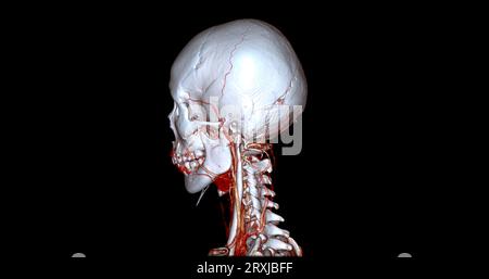 Angiographie TDM du cerveau ou angiographie angiographique du cerveau et du cou vue sagittale 3D mode de fusion d'images . concept de technologie médicale. Banque D'Images