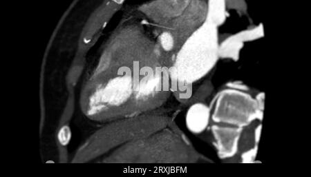 Angiographie coronaire vue verticale grand axe pour le diagnostic de sténose de l'artère coronaire vasculaire. Banque D'Images