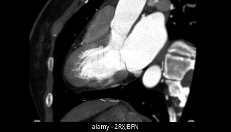 Angiographie coronaire vue verticale grand axe pour le diagnostic de sténose de l'artère coronaire vasculaire. Banque D'Images