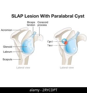 Un kyste paralabral de lésion par CLAQUEMENT dans l'épaule est une déchirure dans le labrum accompagnée d'un kyste, causant souvent douleur, instabilité et limitation fonctionnelle Banque D'Images