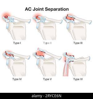 La séparation de l'articulation AC est une lésion de l'épaule impliquant des lésions ligamentaires au niveau de l'articulation acromio-claviculaire. Il provoque la douleur, l'enflure, et la déformation possible, W Banque D'Images