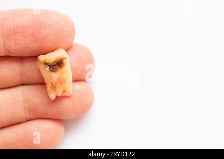 Une fille dans sa main tient une dent extraite avec un trou noir au milieu de la dent gros plan sur un fond blanc, dans sa main, elle tient un malade Banque D'Images