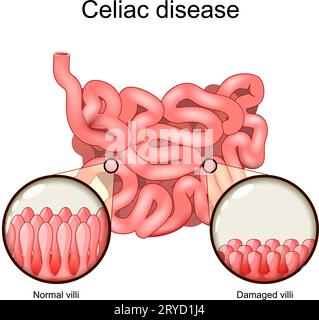 Maladie coeliaque. Coupe transversale d'un intestin grêle avec villosités normales et villosités endommagées. Intolérance au gluten. Maladie auto-immune et sensibilité au gluten Illustration de Vecteur