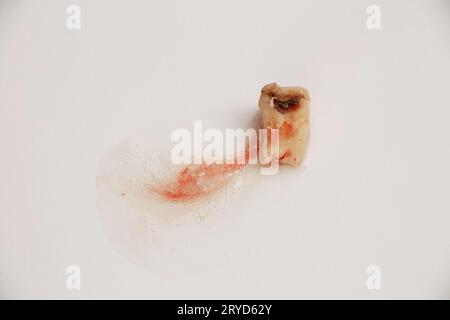 Une dent extraite détruite par des caries et un trou au milieu repose sur un fond blanc avec de la salive avec du sang après avoir enlevé une dent à mâcher par TH Banque D'Images