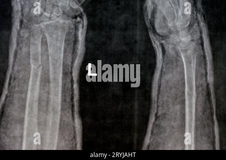 Radiographie simple de l'avant-bras droit (écrite par erreur à gauche sur le film) montrant une fracture de la partie inférieure du cubitus dans le plâtre pendant 4 semaines et a commencé à guérir Banque D'Images