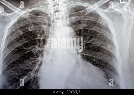 Radiographie thoracique simple d'une vieille femme avec étude presque normale des os, des poumons et du cœur, cavité thoracique normale, côtes et paroi, aucun signe de taches blanches ou Banque D'Images