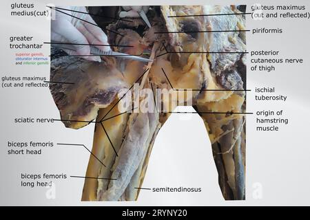 image de dissection de la région fessière montrant l'évolution du nerf sciatique, les muscles ischio-jambiers et le muscle fessier Banque D'Images