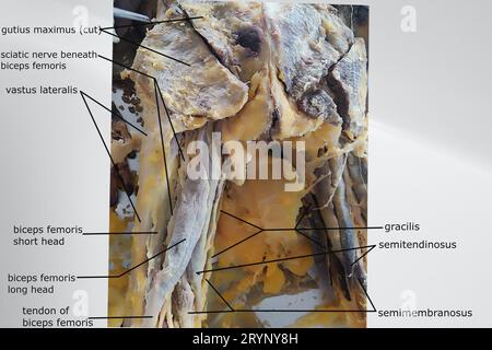 image montrant les muscles de la région fessière et le compartiment postérieur de la cuisse avec les nerfs apparentés Banque D'Images