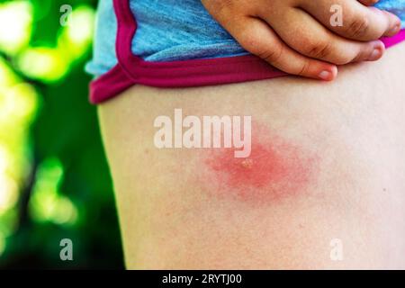 La piqûre de tique sur la jambe, gros plan. Allergie aux piqûres d'insectes. Plaie et conséquences après piqûre de moustique. Peau acnéique. Allergie cutanée Banque D'Images