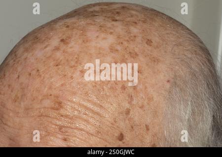 Gros plan détaillé de la tête d'une personne âgée, en se concentrant sur les cheveux gris amincissants, le cuir chevelu ridé et diverses taches cutanées, mettant en évidence le natura Banque D'Images