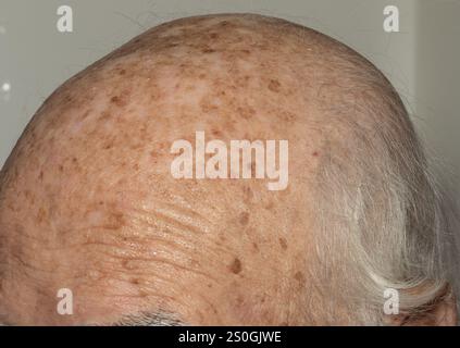 Gros plan détaillé de la tête d'une personne âgée, en se concentrant sur les cheveux gris amincissants, le cuir chevelu ridé et diverses taches cutanées, mettant en évidence le natura Banque D'Images