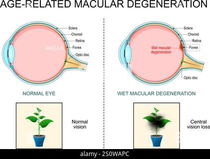 Dégénérescence maculaire liée à l'âge humide. Coupe transversale de l'oeil humain. Distorsion de la vision. Perte de vision centrale. Hémorragie rétinienne. Gros plan d'une macula Illustration de Vecteur