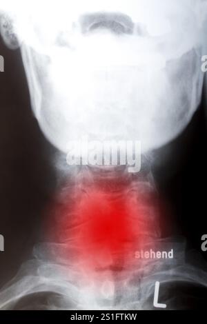 Vertèbres cervicales de face en radiographie Banque D'Images