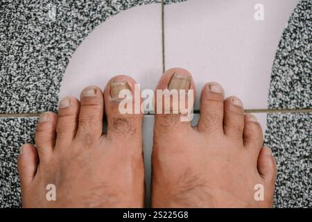 Gros plan du pied d'un homme avec des ongles inégaux des orteils et de légers signes d'ongles incarnés Banque D'Images