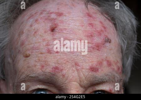 Front de l'homme au cours du traitement de la kératose actinique par le flurouracil pommade. Lésions croûteuses rouges de la peau endommagée par le soleil ou des taches solaires Banque D'Images