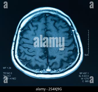 image par résonance magnétique, irm du cerveau. Banque D'Images