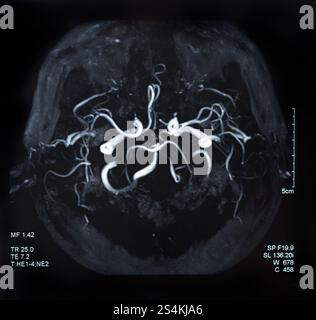 IRM de l'accident vasculaire cérébral et de la maladie vasculaire cérébrale. radiographie cérébrale. Banque D'Images