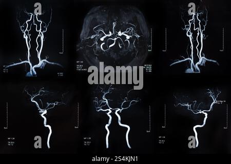 IRM de l'accident vasculaire cérébral et de la maladie vasculaire cérébrale. radiographie cérébrale. Banque D'Images