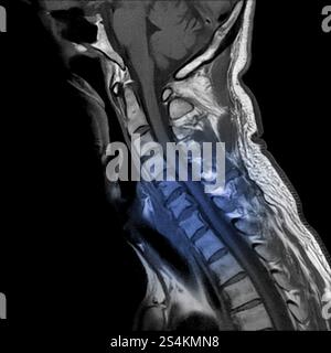 Vue sagittale de l'image de résonance magnétique de l'IRM du rachis cervical montrant la myélopathie spondylotique cervicale qui cause des douleurs cervicales et une faiblesse. (Cervien Banque D'Images