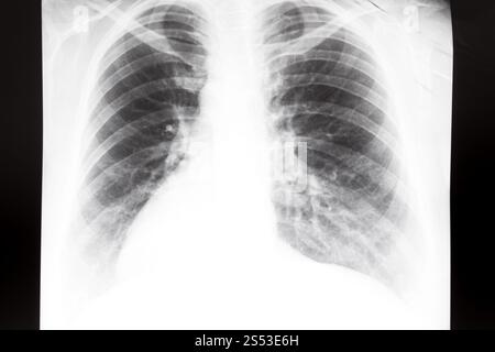 Vue avant du thorax humain avec poumons sur X-ray image Banque D'Images