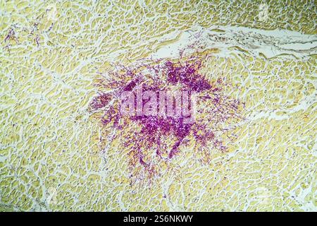 Candida dans le muscle cardiaque d'un malade du SIDA, 100x Banque D'Images