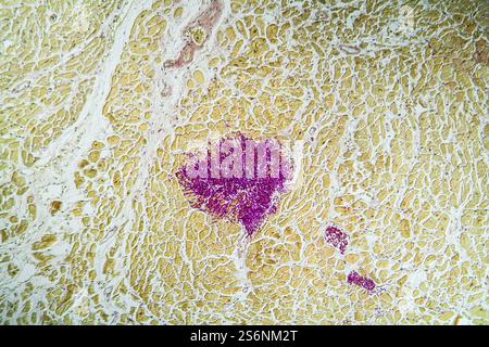 Candida dans le muscle cardiaque d'un malade du SIDA, 100x Banque D'Images