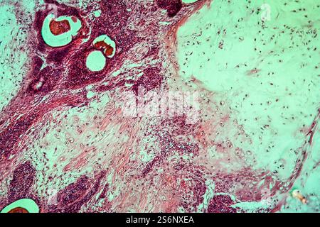 Tissu malade de la glande parotide 100x Banque D'Images