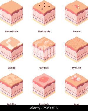 Type de peau. Derme structure corps humain intercouches illustration biologique cellulite dermatologie peles Garish vecteur image isométrique. Anatomie du derme cutané en couches dermatologiques. Type de peau. Derme structure corps humain intercouches illustration biologique cellulite dermatologie peles Garish vecteur image isométrique Illustration de Vecteur
