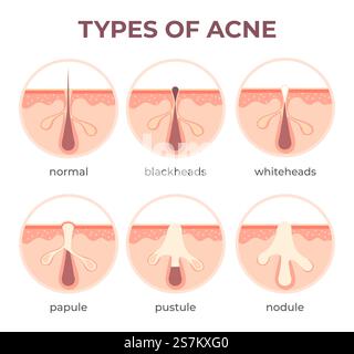 Anatomie des types d'acné. Pimple Diseases vue en coupe Blackhead, kystic et whitehead. Structure de la peau et du vecteur d'infection des pores infographique. Comédons ouverts et fermés. Maladie médicale. Anatomie des types d'acné. Pimple Diseases vue en coupe Blackhead, kystic et whitehead. Structure de la peau et du vecteur d'infection des pores infographique Illustration de Vecteur