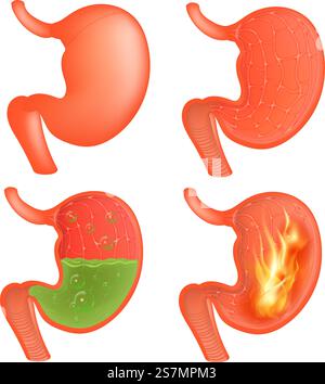 Illustration médicale de l'estomac réaliste à l'extérieur et à l'intérieur. Gastrite et reflux acide, indigestion et douleurs gastriques. Vecteur. Illustration médicale vectorielle de l'estomac réaliste à l'extérieur et à l'intérieur. Gastrite et reflux acide, indigestion et douleurs gastriques. Illustration de Vecteur