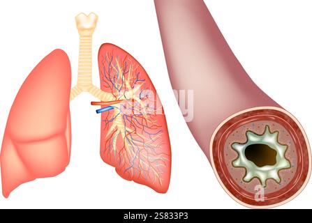 Bronchectasie et augmentation du mucus sécrétoire. Bronche humaine en coupe transversale avec mucus. Infection bactérienne des poumons Illustration de Vecteur