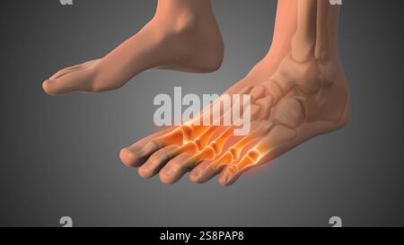 Le concept médical de la douleur de la fasciite plantaire Banque D'Images