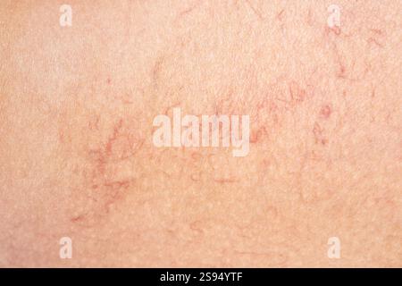 Ablation des varices sur les jambes. Inspection médicale et traitement des télangiectasies. Phlébeurysme. Banque D'Images