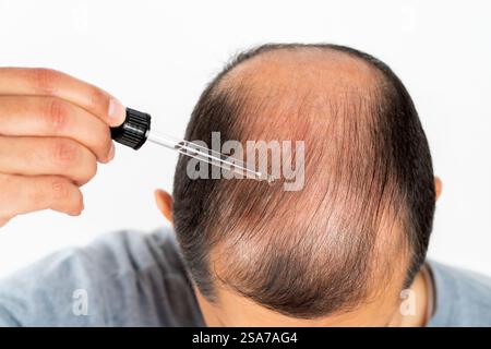Traitement capillaire jeune homme. Massage sain à l'huile d'argan. Gros plan de la personne masculine qui applique un produit pour arrêter la perte de cheveux. La thérapie compte-gouttes cosmétique liquide. Banque D'Images