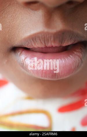 gros plan de la lèvre sèche d'un enfant Banque D'Images